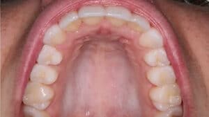 Upper Teeth (occlusal) Example